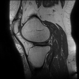 File:Acute-on-chronic transient lateral patellar dislocation with trochlear dysplasia (Radiopaedia 84099-99349 Sagittal PD 111).jpg