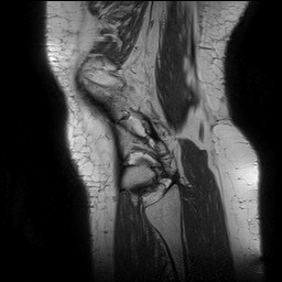 Acute-on-chronic transient lateral patellar dislocation with trochlear dysplasia (Radiopaedia 84099-99349 Sagittal PD 139).jpg