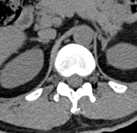 File:Acute L1 burst compression fracture (Radiopaedia 34430-35755 Axial non-contrast 6).png
