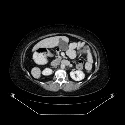Acute appendicitis, heterotaxy syndrome (Radiopaedia 66884-76202 Axial C+ portal venous phase 46).jpg