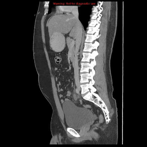File:Acute appendicitis (Radiopaedia 10498-10973 Sagittal C+ portal venous phase 26).jpg