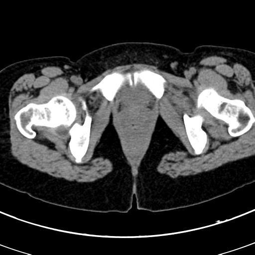 Acute appendicitis (Radiopaedia 30261-30888 Axial non-contrast 113).jpg