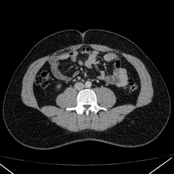 Acute appendicitis (Radiopaedia 38255-40270 Axial C+ portal venous phase 60).jpg