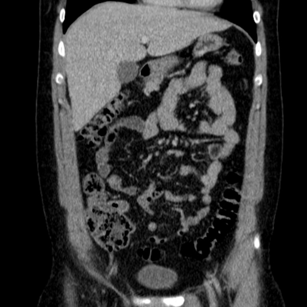Acute appendicitis (Radiopaedia 38255-40270 Coronal C+ portal venous phase 31).jpg