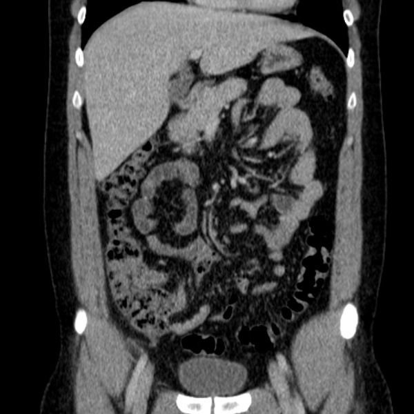 Acute appendicitis (Radiopaedia 38255-40270 Coronal C+ portal venous phase 34).jpg