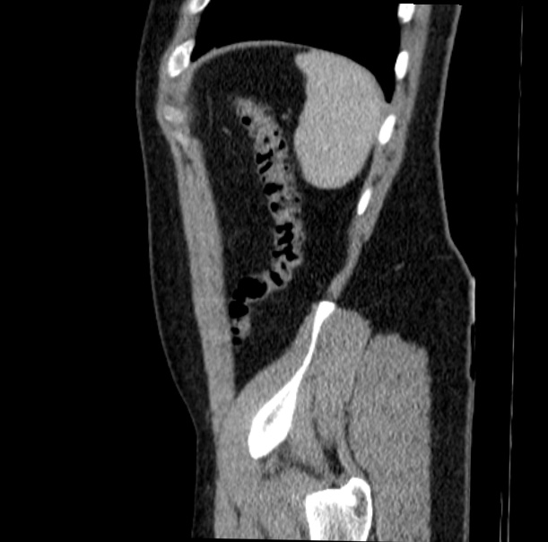 Acute appendicitis (Radiopaedia 38255-40270 Sagittal C+ portal venous phase 71).jpg