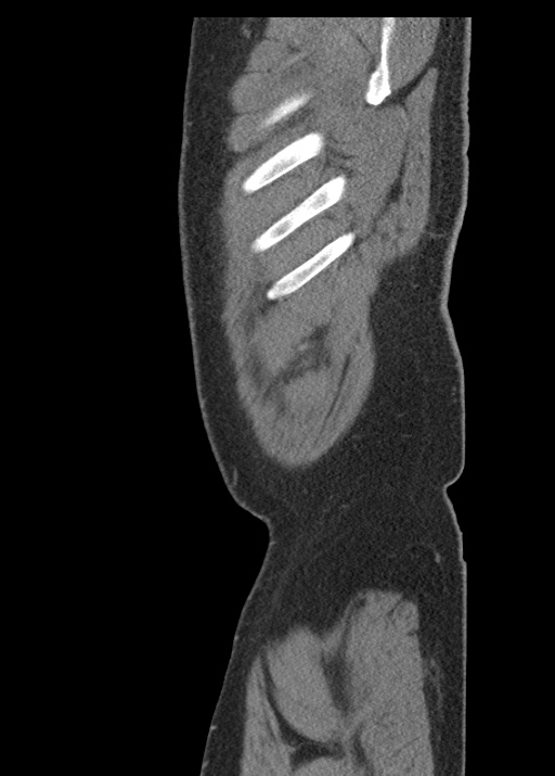 Acute appendicitis (Radiopaedia 48511-53463 Sagittal C+ portal venous phase 18).jpg