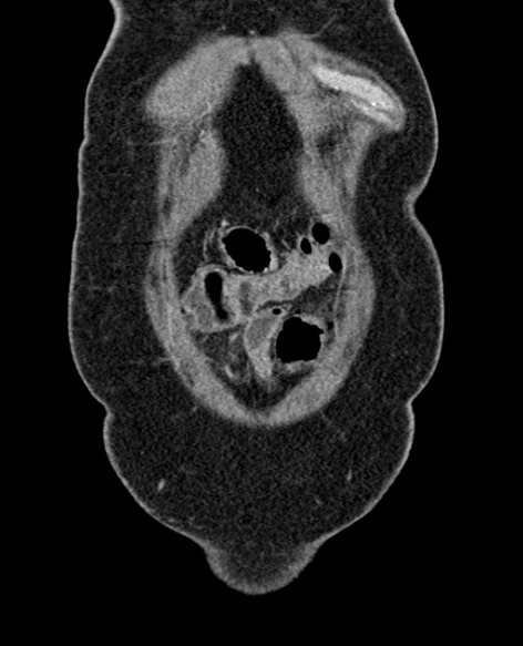 File:Acute appendicitis (Radiopaedia 48792-53822 Coronal C+ portal venous phase 31).jpg