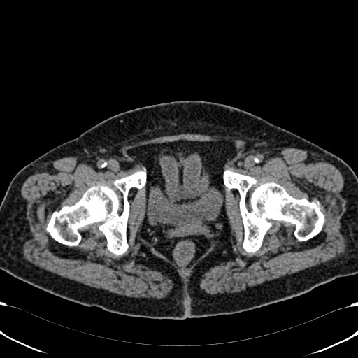 File:Acute appendicitis (Radiopaedia 58627-65818 Axial non-contrast 85).jpg