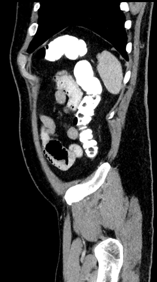 Acute appendicitis (Radiopaedia 77016-88960 Sagittal C+ portal venous phase 18).jpg