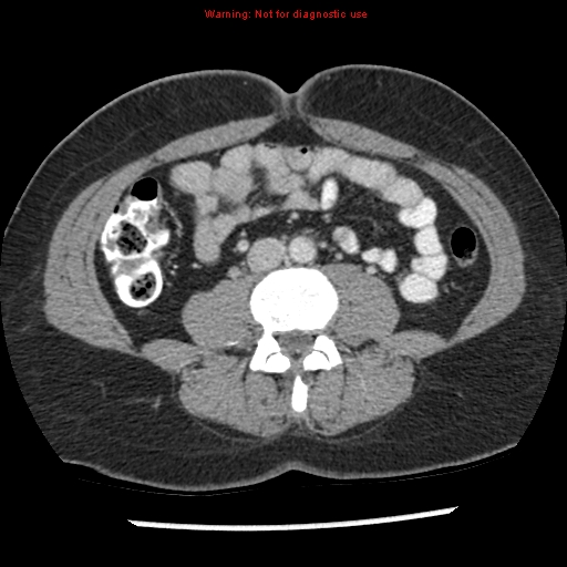 File:Acute appendicitis (Radiopaedia 7966-8812 C+ portal venous phase 26).jpg