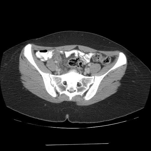 File:Acute appendicitis (Radiopaedia 9417-10099 Axial C+ portal venous phase 5).jpg