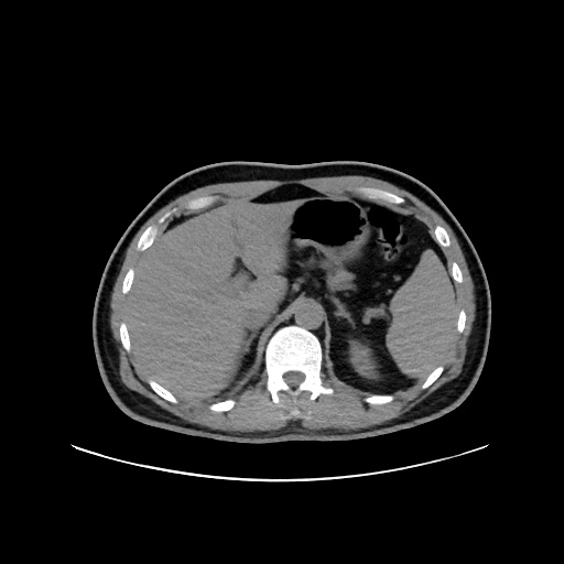 Acute appendicitis and COVID 19 pneumonia (Radiopaedia 76604-88380 Axial non-contrast 56).jpg