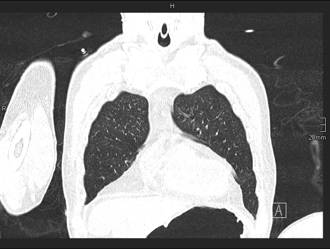 Acute aspiration pneumonitis (Radiopaedia 55642-62166 Coronal lung window 19).jpg