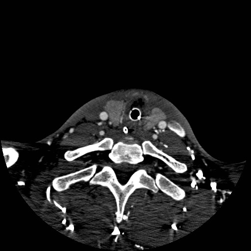 Acute basilar artery occlusion (Radiopaedia 43582-46985 Axial C+ arterial phase 267).jpg
