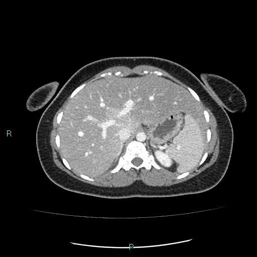 Acute bilateral pyelonephritis (Radiopaedia 37146-38881 Axial C+ portal venous phase 22).jpg