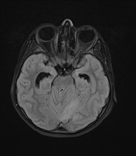 File:Acute cerebellar ataxia (Radiopaedia 61487-69446 Axial FLAIR 7).jpg