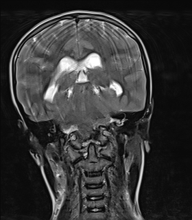 File:Acute cerebellar ataxia (Radiopaedia 61487-69446 Coronal T2 9).jpg