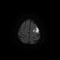 File:Acute cerebral infarct (Radiopaedia 30707-31410 Axial DWI 4).jpg