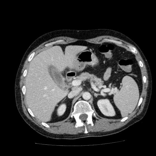 Acute cholecystitis and incidental left sided IVC (Radiopaedia 49352-54459 Axial C+ portal venous phase 50).jpg