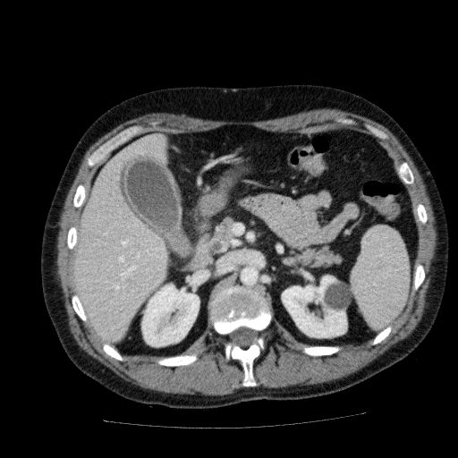 Acute cholecystitis and incidental left sided IVC (Radiopaedia 49352-54459 Axial C+ portal venous phase 57).jpg
