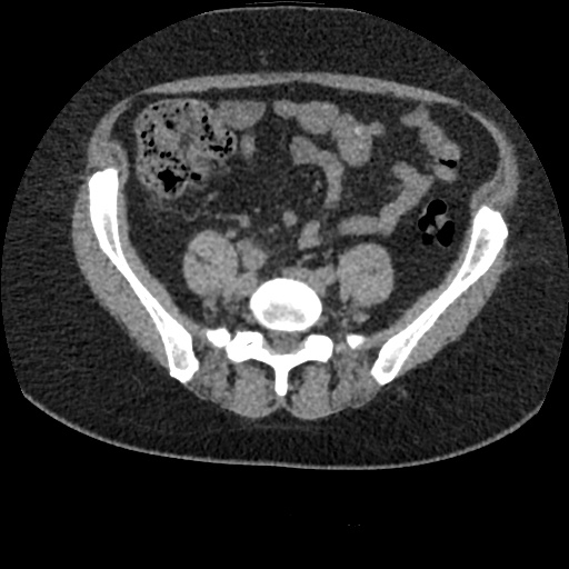 File:Acute cholecystitis and ureteric colic (Radiopaedia 42330-45444 Axial prone 72).jpg