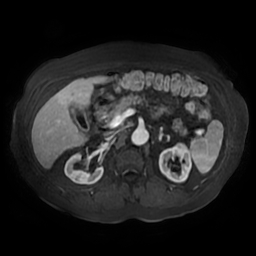File:Acute cholecystitis complicated by pylephlebitis (Radiopaedia 65782-74915 Axial arterioportal phase T1 C+ fat sat 67).jpg