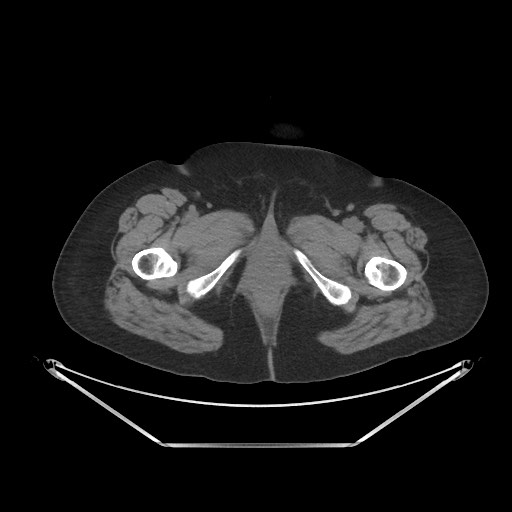 File:Acute cholecystitis with tensile fundus sign (Radiopaedia 71394-81723 Axial non-contrast 129).jpg
