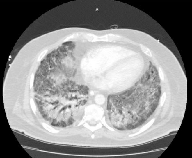 File:Acute cor pulmonale (ultrasound) (Radiopaedia 83508-98818 Axial lung window 61).jpg