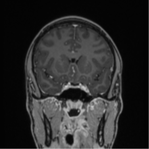 Acute disseminated encephalomyelitis (ADEM) (Radiopaedia 65319-74349 Coronal T1 C+ 36).png