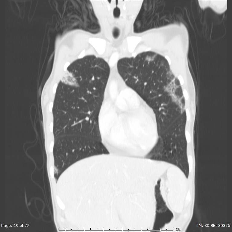 Acute eosinophilic pneumonia (Radiopaedia 48211-53073 Coronal lung window 12).jpg