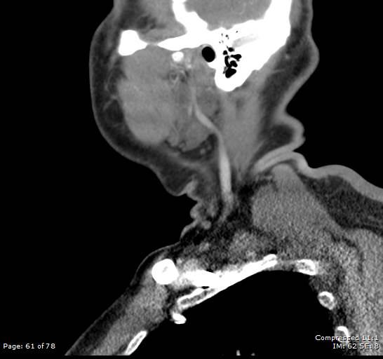 Acute epiglottitis (Radiopaedia 54375-60590 Sagittal C+ arterial phase 61).jpg