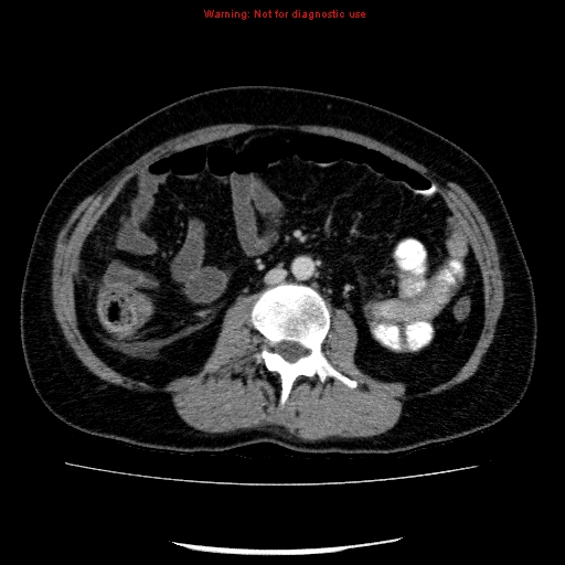 Acute gangrenous cholecystitis (Radiopaedia 10123-10661 Axial C+ portal venous phase 54).jpg