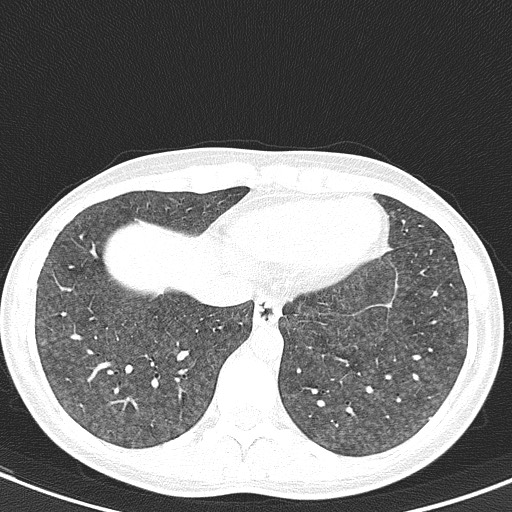 File:Acute hypersensitivity pneumonitis (Radiopaedia 85293-100870 Axial lung window 94).jpg