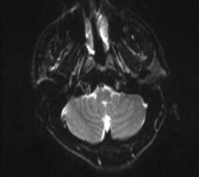 Acute ischemic stroke - posterior circulation territory (Radiopaedia 77670-89880 Axial DWI 4).jpg