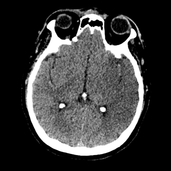Acute middle cerebral artery territory infarct (Radiopaedia 52380-58283 Axial non-contrast 48).jpg