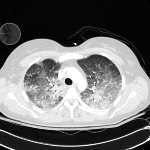Acute myocardial infarction in CT (Radiopaedia 39947-42415 Axial lung window 33).jpg