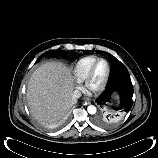 Acute pancreatic necrosis (Radiopaedia 13560-18500 Axial C+ portal venous phase 20).jpg