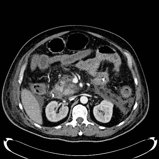 Acute pancreatic necrosis (Radiopaedia 13560-18500 Axial C+ portal venous phase 61).jpg