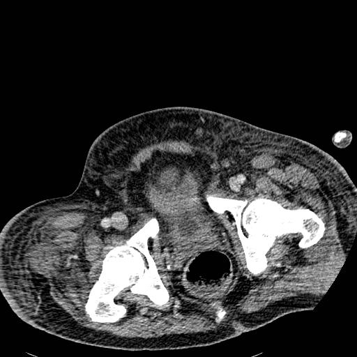 Acute pancreatic necrosis (Radiopaedia 13560-18501 Axial C+ portal venous phase 144).jpg