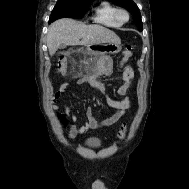 Acute pancreatitis (Radiopaedia 26663-26813 Coronal C+ portal venous phase 18).jpg