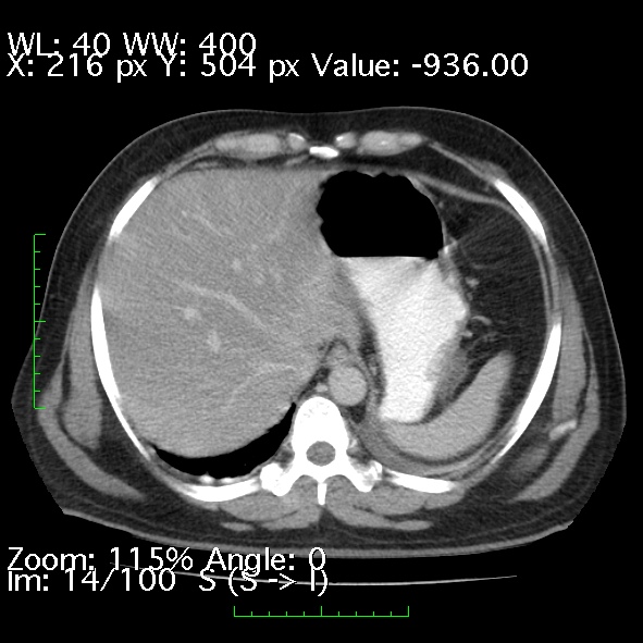 Acute pancreatitis (Radiopaedia 34043-35276 Axial C+ portal venous phase 14).jpg
