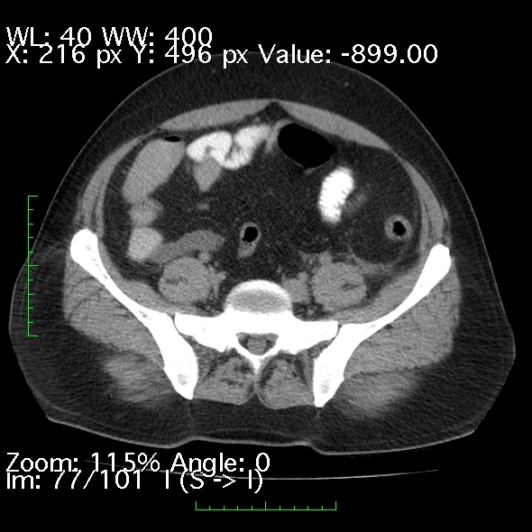 Acute pancreatitis (Radiopaedia 34043-35276 Axial non-contrast 77).jpg