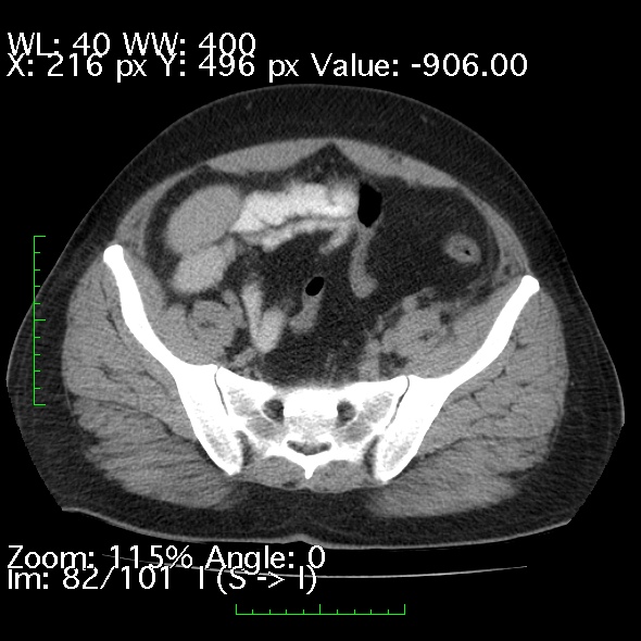 Acute pancreatitis (Radiopaedia 34043-35276 Axial non-contrast 82).jpg
