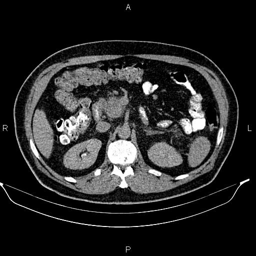 File:Acute pancreatitis (Radiopaedia 85390-101010 Axial C+ delayed 28).jpg
