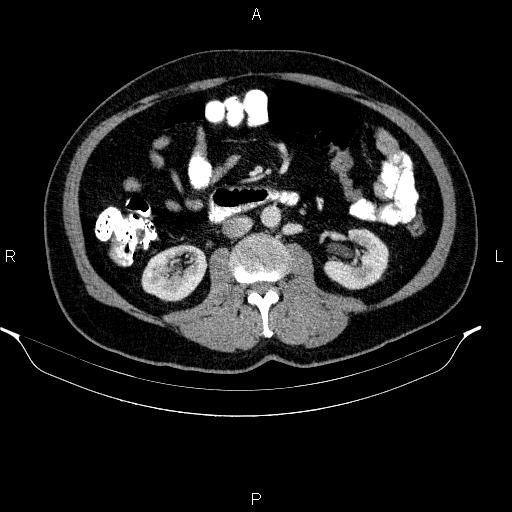 Acute pancreatitis (Radiopaedia 85390-101010 Axial C+ portal venous phase 52).jpg