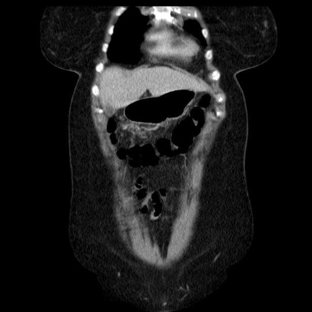 Acute pancreatitis - Balthazar C (Radiopaedia 26569-26714 Coronal C+ portal venous phase 17).jpg