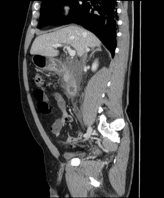 Acute pancreatitis - Balthazar E (Radiopaedia 23080-23110 Sagittal C+ portal venous phase 36).jpg