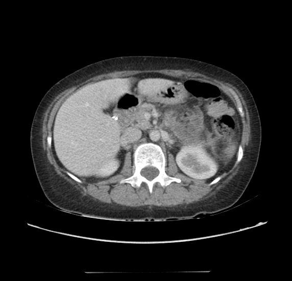 File:Acute pancreatitis - Balthazar E - post ERCP (Radiopaedia 27562-27772 Axial C+ portal venous phase 28).png