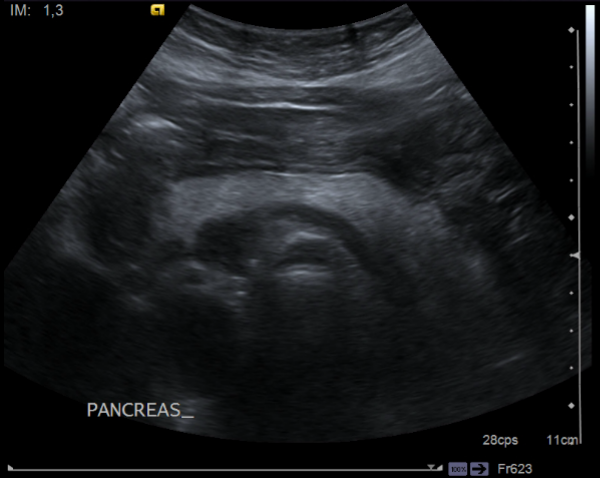 File:Acute pancreatitis - Balthazar E - post ERCP (Radiopaedia 27562-27775 Transverse 11).png